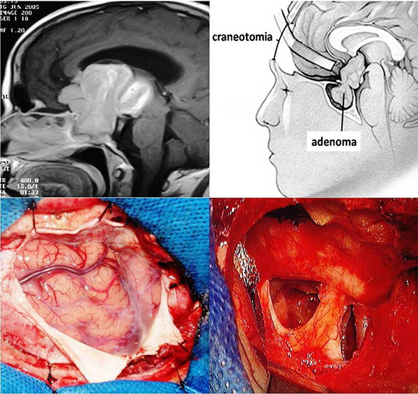 microadenoma hipofisiario de 4mm